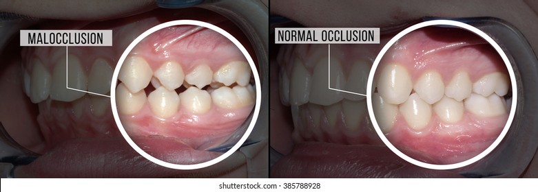 Treatment Malocclusion: Before And After