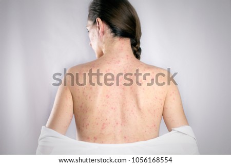 treatment Rubella viral infection concept. girls back skin rashes