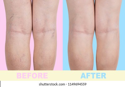 Treatment of varicose before and after. Varicose veins on the senior female legs. Before after concept. Phlebology 