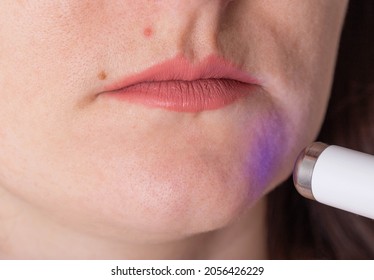 Treatment Of Wrinkles And Problem Skin On The Face With A Laser Pen. Removing Red Acne, Macro, Cosmetologist