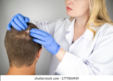 Ein Trichologe untersucht das Haar eines Mannes, der Alopezie beginnt. Beratung mit einem Dermatologen. Haarausfall, Alopezie, Pruritus, brennender Kopf oder Seborrhoe