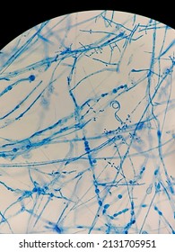 Trichophyton Mentagrophytes With Spiral Hyphae Seen