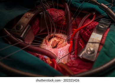 Tricuspid Valve Repair