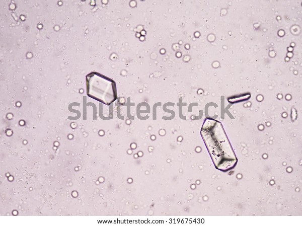 Triple Phosphate Crystal Urine Sediment Stock Photo (Edit Now) 319675430