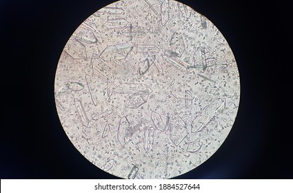 Triple Phosphate Crystals In Canine Urine Sediment. Crystals In Alkaline  Urine. Urinalysis Test. Urine Sediment.