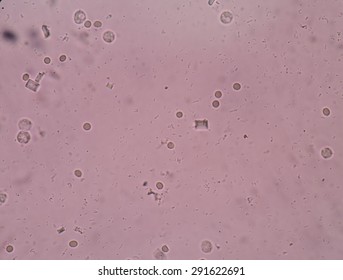 Triple Phosphate Crystals In Human Urine.