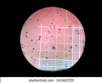 Triple Phosphate Crystals On Urine Test