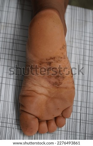 Tropical skin disease of a young indigenous woman in the Amazon, Brazil. Dermatitis rash under the foot that has persisted for three months. Near the village of Terra do Caju, Amazonas state, Brazil.