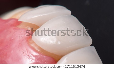 Try in and insert of white dental Ceramic veneers on discoloured and yellow teeth.