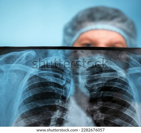Tuberculosis. Disease lung cancer. Surgeon radiographer, in hospital, Medical worker analyzes x-ray of lungs, doctor examines pneumonia, respiratory disease. Pulmonary complication in humans