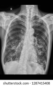 Tuberculosis And Pulmonary Tuberculosis And Chest Xray