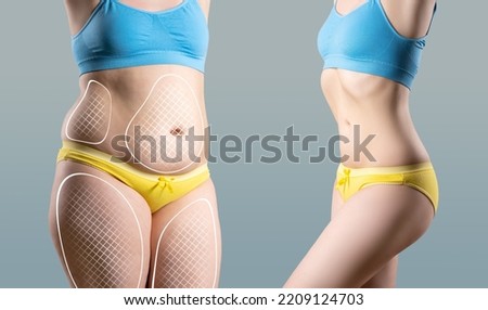 Tummy tuck, cellulite removal, woman's body before and after liposuction on gray studio background, plastic surgery concept