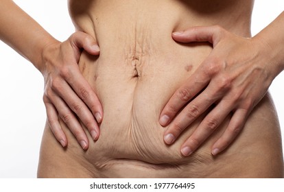 Tummy Tuck Woman Waist After Gastric Bypass, C Section Scar And Excess Skin, Flabby Belly After Pregnancy Close Up