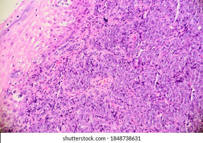 Tumor Called Diffuse Large B Cell Lymphoma Of The Tonsil. Microscopic View.