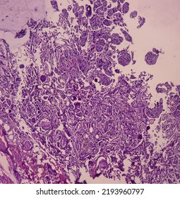 Tumor From Dorsal Spine (biopsy): Psammomatous Meningioma. Heavily Calcified Intracranial Or Spinal Mass Lesion, Show Soft Tissue Of Spine.