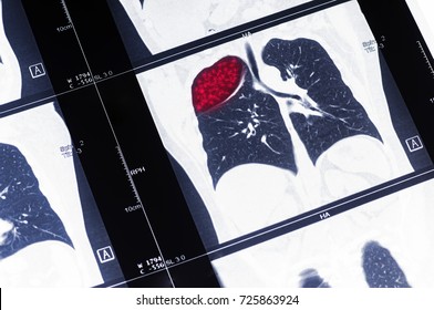 Tumor. Lung Cancer. The MRI Highlighted In Red Tumor. The Effects Of Smoking