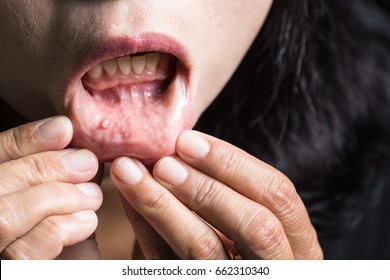 Tumor in the mouth,MUCOCELE LIP. - Powered by Shutterstock
