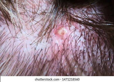 802 Folliculitis Images, Stock Photos & Vectors | Shutterstock