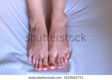 Tumor, trauma, inflammation of joint, leg ankle hygroma in joint, feet closeup on white background. Trauma, shock, swelling of internal tissues. Joint disease.