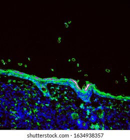 Tumour Immunofluorescence IHC Image Of Immunotherapy Treatment. Tumor Cells In Blue Attacked By Immune System T Cells Lymphocytes In Green