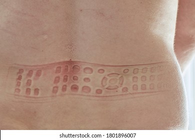 TV Remote Control Impression On The Skin On Back Of Male Caucasian Person. 