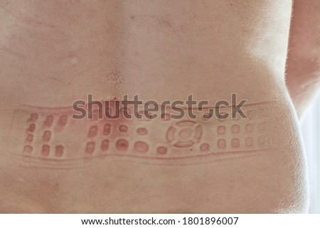 TV remote control impression on the skin on back of male caucasian person. 
