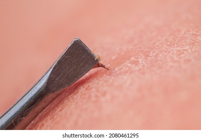 Tweezers Extract Bee Sting With Insect Venom From Human Skin