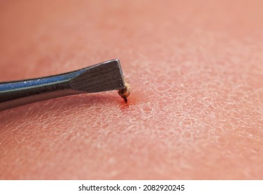 Tweezers Extract Bee Sting With Insect Venom From Human Skin