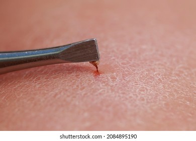 Tweezers Extract Bee Sting With Insect Venom From Human Skin