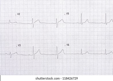 Twelve Lead Electrocardiogram Graph With Abnormal First Degree AV Block