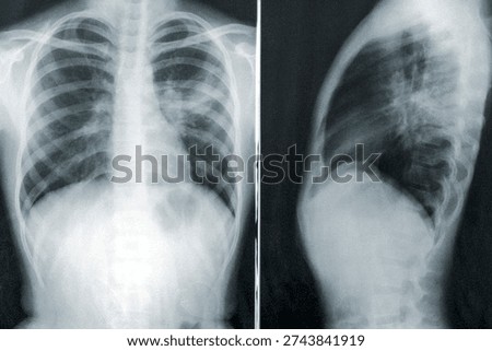 Two chest x-rays in the case of a child with a case of mycoplasma pneumonia. Original image sourced from US Government department: Public Health Image Library, Centers for Disease Control and Prevention. Under US law this image is copyright free, please credit the government department whenever you can”.