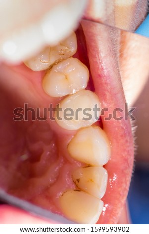 two chewing side teeth of the upper jaw after treatment of caries. Restoration of the chewing surface with a photopolymer filling material using the Rubber Dam system