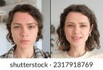 Two close up faces of young beautiful woman show real result before and after acne treatment. Split screen. Home background. Concept  of acne therapy, scars, inflammation on face and problem skin. UGC