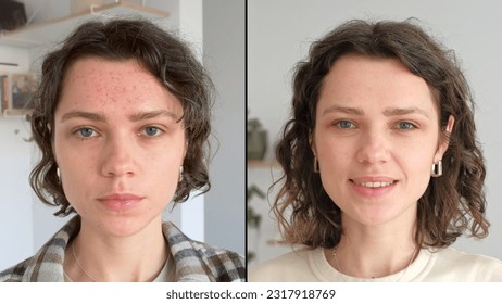 Two close up faces of young beautiful woman show real result before and after acne treatment. Split screen. Home background. Concept  of acne therapy, scars, inflammation on face and problem skin. UGC - Powered by Shutterstock