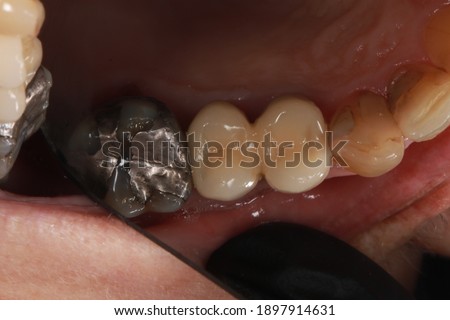 two crowns with an adjac3nt failed amalgam filling