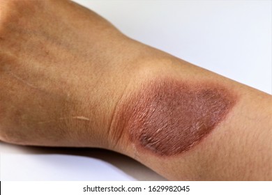 Two Days Old Burn Cause By Very Hot Steam Coming From The Electric Kettle On Right Forearm Of A Female With Dark Skin. Isolated Photo On White Background. Taken On January 27, 2020