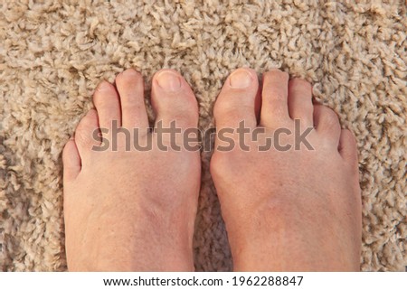 Two feet on carpet show bunions and misaligned toes