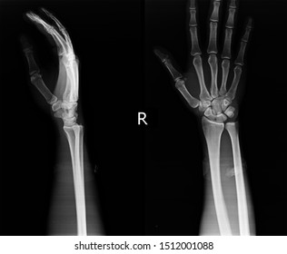 Two Hands Skeleton On Xray Stock Photo 1512001088 | Shutterstock