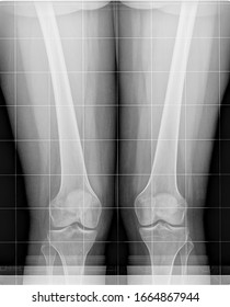 Two Knees With A Genu Valgum X Ray Scan. Radiograph Examination.