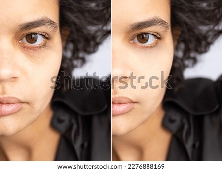Two photographs compared the effect before and after treatment. Under eyes with problems of dark circles, puffiness and periorbital wrinkles before and after treatment to solve the skin problem 