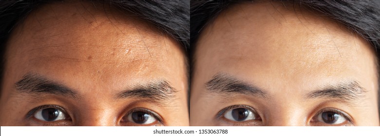 two pictures compared effect Before and After treatment. skin with problems of freckles , pore , dull skin and wrinkles around forehead before and after treatment to solve skin problem for better skin - Shutterstock ID 1353063788