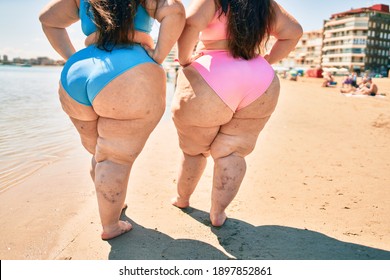 Two plus size overweight women showing legs vascular disease of varicose and thrombosis at the beach