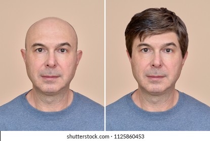 Deux portraits du même homme chauve d'âge mûr avant et après avoir porté une perruque