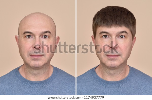 かつらを被る前後の同じ中年の禿頭の肖像2点 の写真素材 今すぐ編集