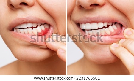 Two shots of a young woman with red bleeding gums and health gums, before and after treatment on a white background. Result of curing of gum inflammation. Close up. Dentistry, dental care. Comparison
