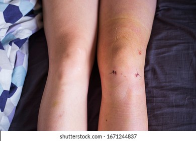 Two small scars and stitches on woman's left leg knee after surgical procedure knee arthroscopy surgery  to repair meniscus  trauma and remove plica. Suffering from pain and runners knee syndrome.