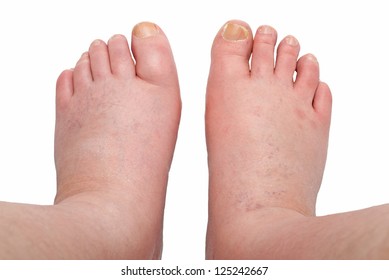 Two Swollen Legs With Fungal Infection Isolated On White Background