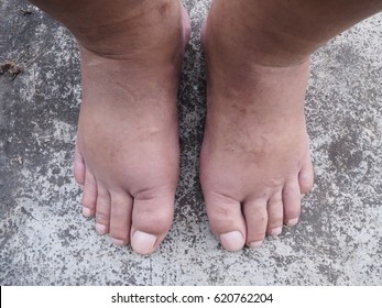 Two Swollen Legs With Fungal Infection On Concrete Floor