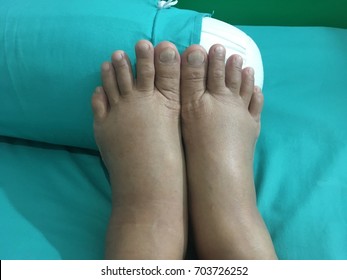  Two Swollen Legs Of Pregnant Woman