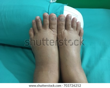  two swollen legs of pregnant woman